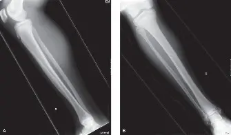 ورم الأدامانتينوما في قصبة الساق: دليل شامل للتشخيص والعلاج والتعافي