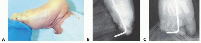 Illustration 19 for Resistant Clubfoot Solved: Posteromedial and Posterolateral Release