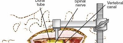 Illustration 16 for Approach to the Lumbar Spine: Mastering Techniques & Anatomy
