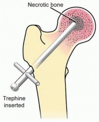Head-Sparing for Osteonecrosis of the Femoral: Preserve Your Hip