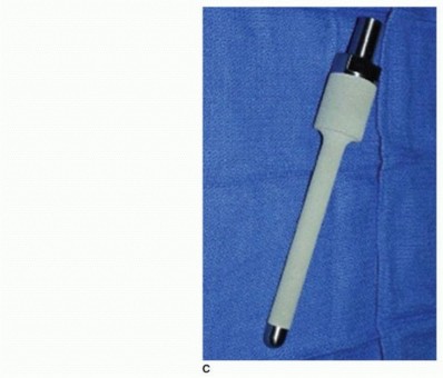Illustration 39 for Allograft Prosthetic Composite: Mastering Proximal Femur Reconstruction