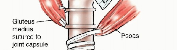 Illustration 4 for Beyond Amputation: Total Femur Resection with Endoprosthetics