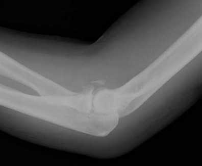 Illustration 169 for OrthoCash: Trauma MCQs & Cases for a yearold woman