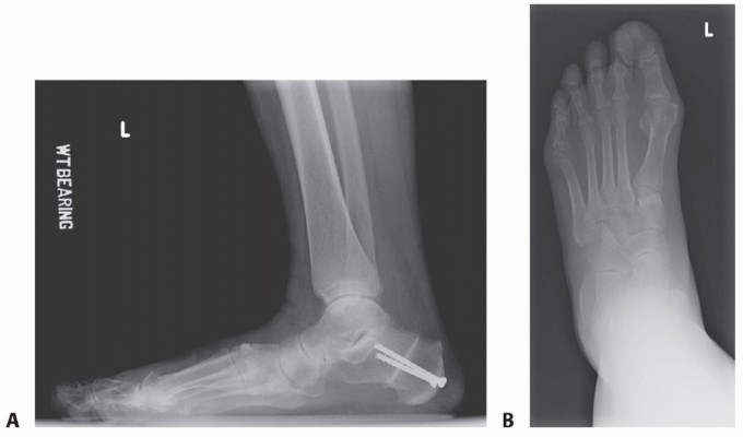 Illustration of medial cuneiform osteotomy - Dr. Mohammed Hutaif