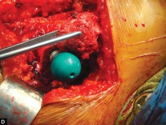 Illustration 50 for The Silent Hip: Achieving a Truly Silent, Pain-Free Joint