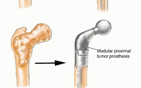 Illustration 15 for Plain Radiograph Showing MBD: Surgical Planning to Prevent Failures