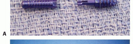 Illustration 9 for Hammer Toe Correction: Understanding the Extensor Digitorum Longus