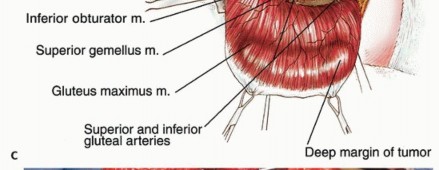 Illustration 10 for Beyond Hemipelvectomy: Preservation of the Sciatic in Buttock Surgery