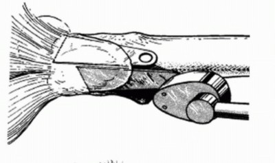 Illustration 26 for Sliding Trochanteric Osteotomy: Modern Role & Refined Techniques