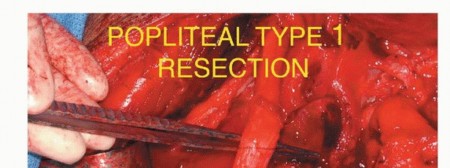 Illustration 17 for Optimizing Resection: An Overview of Surgical Approaches for Space Sarcomas