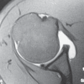 Illustration 7 for Resolve Long Head Biceps Pain: Advanced Arthroscopic Treatment