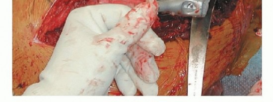 Illustration 11 for Limb Salvage: New Advances in Proximal Femoral Replacement