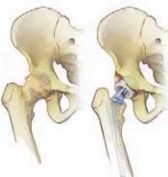 Illustration 10 for Advanced Arthroplasty for Malignant Lesions: Reclaim Your Mobility
