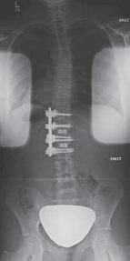 Illustration 9 for Mastering Anterior Interbody Arthrodesis with Instrumentation for Scoliosis