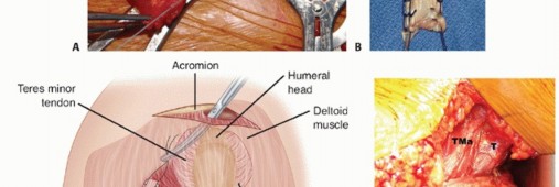 Illustration 22 for Restore Shoulder Function with Latissimus Dorsi Tendon Transfer
