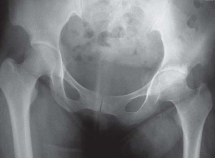 Illustration 70 for The Silent Hip: Achieving a Truly Silent, Pain-Free Joint