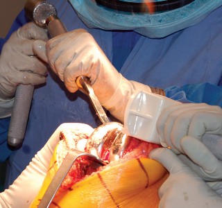 Illustration 31 for Mastering Gap Balancing in Revision TKA: Avoid Common Pitfalls