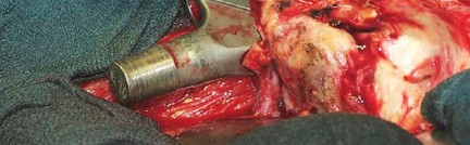 Illustration 22 for Optimizing Infected THA: The One Staged Approach Explained