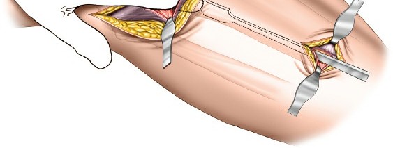 Illustration 56 for Surgical Access: Mastering the Tibia's Surface & Fibula Approaches
