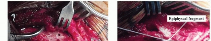 Sternoclavicular Fracture Injury: Prompt Diagnosis for Critical Cases