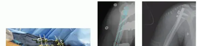 صورة توضيحية لـ كسور عظم العضد: دليل المريض الشامل للعلاج والتعافي مع الأستاذ الدكتور محمد هطيف