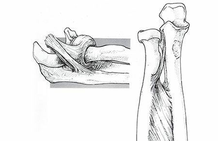 Illustration of radius and ulna - Dr. Mohammed Hutaif