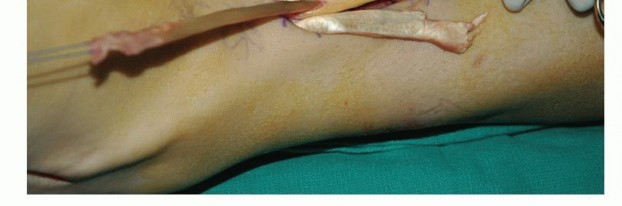 Illustration 50 for Foot Drop Surgery: How a Pin or Drill Elevates Tendon Transfer