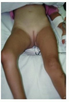 Illustration 3 for Septic Hip in Children: Mastering Anterior Drainage for Optimal Recovery