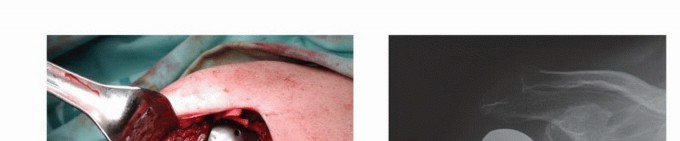 Illustration 22 for Restore Vital Function: Surgery for Type II Humeral Metastasis