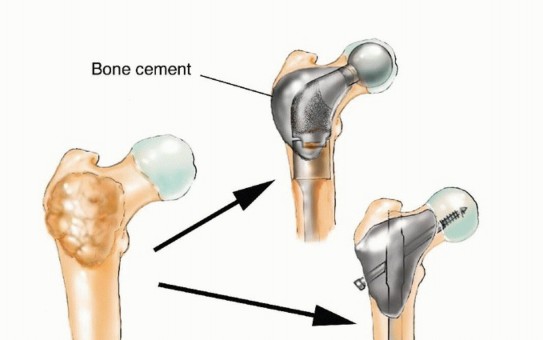 Illustration 14 for Plain Radiograph Showing MBD: Surgical Planning to Prevent Failures