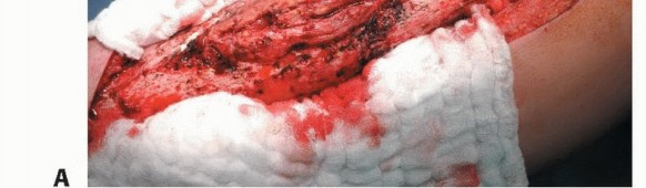 Illustration 15 for Free Vascularized Fibular Grafts: Solving Complex Bone Defects