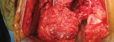 Illustration 21 for Optimizing Arthroplasty in Acute Fractures: Octopus System