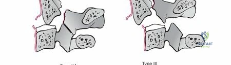Illustration of c lateral mass - Dr. Mohammed Hutaif