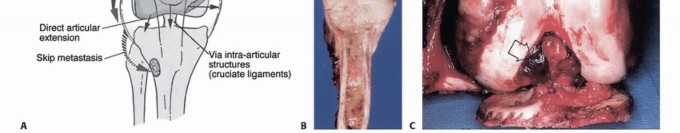 Illustration 11 for Understanding Benign Bone Tumors: Your Complete Preoperative Guide