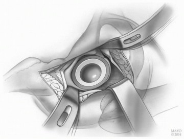 صورة طبية: النهج الأمامي لاستبدال مفصل الورك الكلي: ثورة في جراحة الورك مع الأستاذ الدكتور محمد هطيف في صنعاء