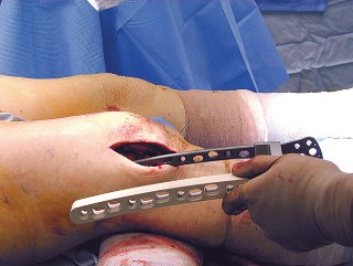 Illustration 12 for Mastering Periprosthetic Femoral Fractures Above Knee Arthroplasty