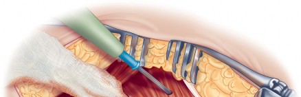 Illustration 43 for Direct Lateral Hip: Optimize Exposure with Sharp Curved Hohmann