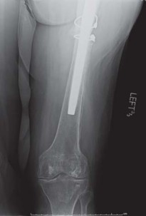 Illustration 46 for THA for patients with proximal femoral deformity: Practical solutions