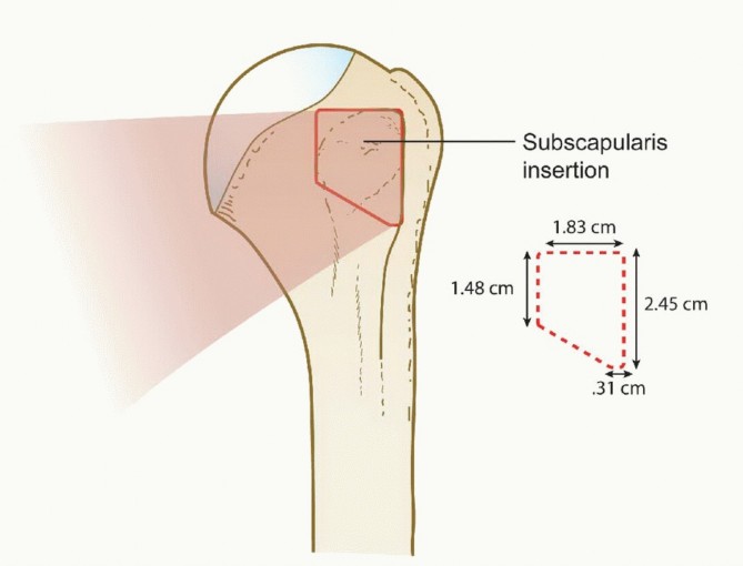 Illustration of treatment of subscapularis tears - Dr. Mohammed Hutaif
