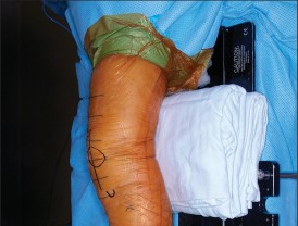 Illustration 17 for PROSTALAC Articulating Spacer: Treat Infected Knees, Regain Mobility