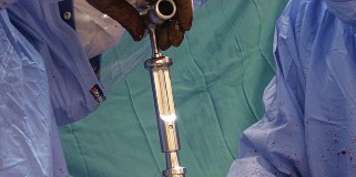 Illustration 31 for Hinged Total Knee: The Salvage Solution for Challenging Cases