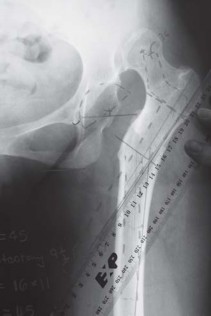 Illustration 24 for Successful Total Hip Replacement in Developmental Dysplasia