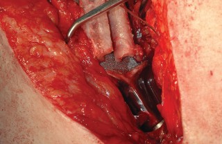 Illustration 87 for Femoral Stem Revision: Posterior Approach for Better Outcomes