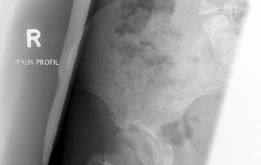 Illustration 5 for Bernese Periacetabular Osteotomy: Your Definitive Case Title Bernese