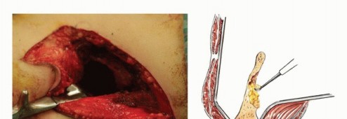 Illustration 31 for Pelvic Metastasis Surgery: A Component of the Utilitarian Approach