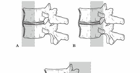 Illustration of spinal stability spinal - Dr. Mohammed Hutaif