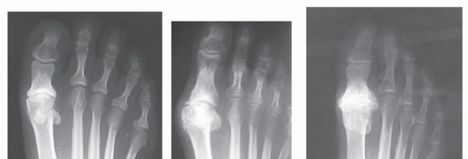 Illustration 7 for End Articular Cartilage Loss: Arthrosurface HemiCAP Resurfacing