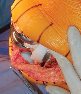 Illustration 65 for Mastering Gap Balancing in Revision TKA: Avoid Common Pitfalls