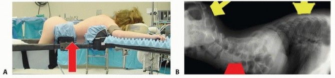 Illustration 11 for Duchenne Muscular Dystrophy: Is Spinal Fusion the Answer?