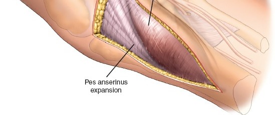 Illustration 40 for Surgical Access: Mastering the Tibia's Surface & Fibula Approaches